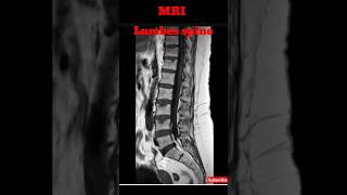 MRI Lumbar spine  Epidural Lipomatosis radiology mrilumbarapime shorts mricase [upl. by Norrehc78]