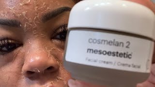 My unbelievable 30 day Cosmelan Peel journey [upl. by Hurff]