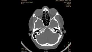 tac craneal [upl. by Ellebana]