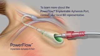 PowerFlow Implantable Apheresis IV Port Access Video [upl. by Attenwahs]