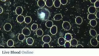 Acanthocytes  Live Blood Analysis Training Course [upl. by Kelly]