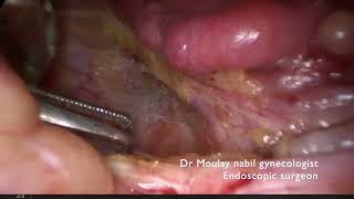 Outpatient polymyomectomy with vascular control [upl. by Bryana210]