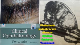 Lecture 6 Phthiriasis Palpebrarum  Eyelid disease eyelecture optometry medicalfeild eyes [upl. by Norreht]