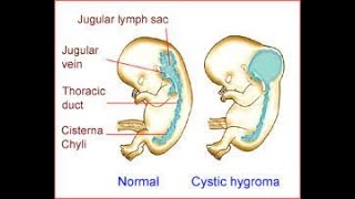 Applied anatomy of posterior triangle of the neck  Troisers sign  Cystic hygroma  Cystic lymphan [upl. by Ange]