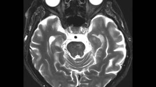 Bilateral ICA Occlusion [upl. by Barty]