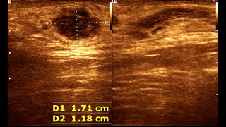 Sonography of adenomatoid Tumor spermatid cord  Spermatic cord tumor [upl. by Alistair]