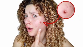 ARE YOUR CURLY HAIR PRODUCTS CAUSING ACNE causes symptoms and solutions [upl. by Stander]