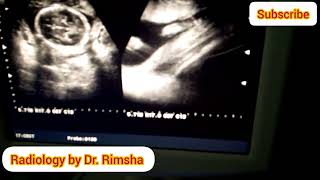 Anterior placenta and baby boyGender prediction on ultrasound Baby boy on ultrasound [upl. by Porush413]