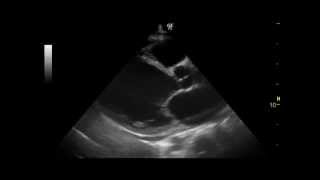 Dilated Cardiomyopathy  QMH AED Ultrasound Casebook 201203 Video 1 [upl. by Nodyroc]