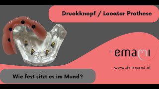 Gaumenfreie Prothese Druckknopf Prothese Locator Prothese Steg Prothese Prothese auf Implantate [upl. by Nan]