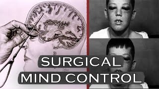 The Most BRUTAL Surgical Procedure  The Lobotomy  Dark History Documentary [upl. by Zizaludba142]