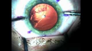 Clear lens extraction with Alcon Acrysof IQ Restor Toric DrMishevavi [upl. by Tess]