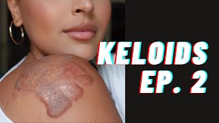 My Keloid Journey  Ep 2  Treatments amp Scar Camouflage at The Basma Hameed Clinic Toronto [upl. by Artemis]