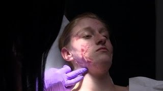 Hope for Teen Suffering from Hidradenitis Suppurativa [upl. by Hgieleak]