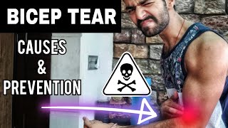 Bicep Tendon Tear  Causes amp Prevention HINDI [upl. by Stahl]