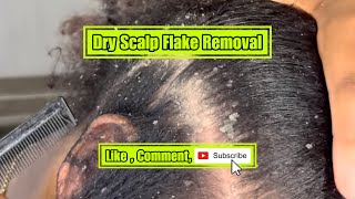 Dry scalp Flake removal [upl. by Rockefeller]