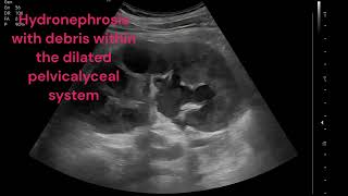 RIGHT PYELONEPHRITIS WITH PYONEPHROSIS [upl. by Addis]