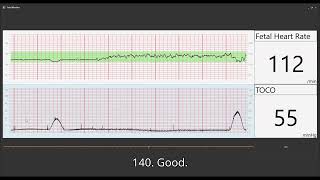 Fetal Heart Monitoring [upl. by Frances]