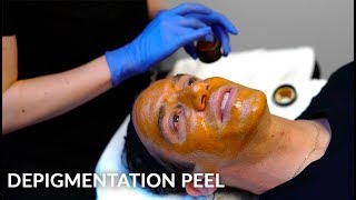 Depigmentation Peel  Melasma amp Hyperpigmentation Treatment  Live [upl. by Ozner]