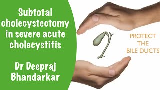 Subtotal cholecystectomy in severe acute cholecystitis [upl. by Nileuqay365]