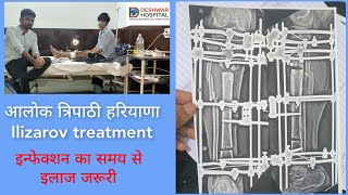 tibia fibula bone fracture infection nonunion case treatment with Ilizarov in Deshwar hospital [upl. by Nattirb452]