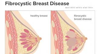 Benign Breast Diseases  ANDI by Prof Dr A P Singh [upl. by Sellma]