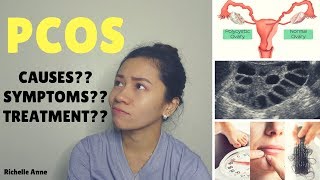 PCOS  Causes Symptoms Treatment  Tagalog [upl. by Waylin]