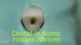 Cavidad de acceso incisivos inferiores  access cavity lower incisors [upl. by Zildjian108]