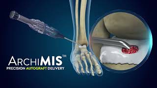 ArchiMIS  Precision Autograft Delivery  Launch Video [upl. by Florry]