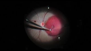 Macroaneurysm Bleeding and Retinal Detachment [upl. by Messing350]