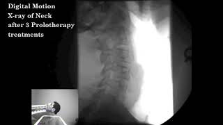 Digital Motion Xray before and after Prolotherapy [upl. by Lacagnia681]