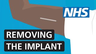 Removing the contraceptive implant  NHS [upl. by Ihskaneem]