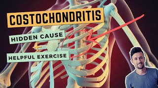 Costochondritis The Hidden Cause and a Simple Exercise to Fix Anterior Rib Joint Pain [upl. by Eiramlatsyrc]