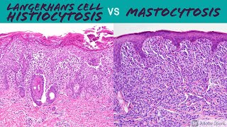 Langerhans Cell Histiocytosis vs Mastocytosis Hemepath for Dermatopathology Pathology Dermatology [upl. by Husein]