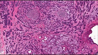 Salivary gland Polymorphous adenocarcinoma and differential [upl. by Nreval]