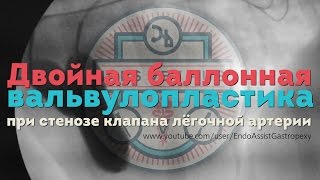 Двойная баллонная вальвулопластика Double Balloon Valvuloplasty in dog [upl. by Eirrej]