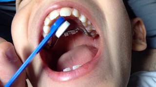 HOW TO ADJUST A RAPID PALATAL EXPANDER [upl. by Ymmas599]