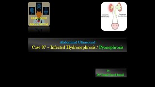 Ultrasound Case 87 Infected Hydronephrosis  Pyonephrosis [upl. by Hearsh]