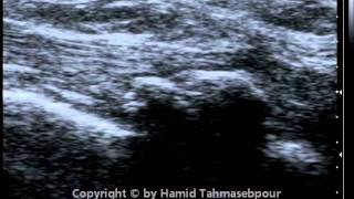 Peroneus Longus Tendon [upl. by Llerut391]