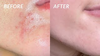 How I COMPLETELY got rid of my PERIORAL DERMATITIS in 4 DAYS the secret cure [upl. by Herminia393]