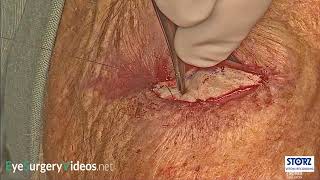 Lower lid cicatricial ectropion repair with full thickness skin graft [upl. by Timon]