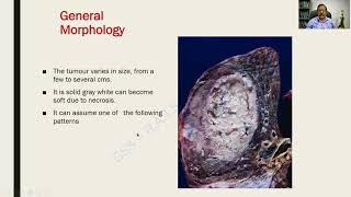 Bronchogenic Carcinoma Part I  Respiratory Pathology  RATS [upl. by Rosabelle]