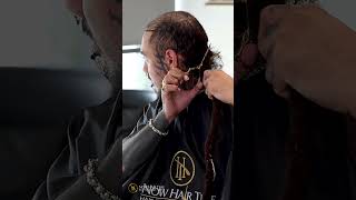 Hair Transplant Journey nowhairtime hairtrasnplantturkey hairtransplant [upl. by Nivk]