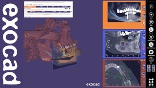 exocad Video Tutorial exoplan [upl. by Service452]