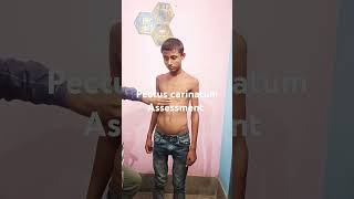 pectus carinatum child assessment [upl. by Einahpetse]