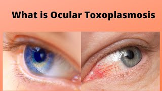 What is Ocular Toxoplasmosis [upl. by Ardnauq]