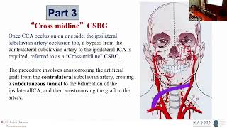 Complex Extracranial Bypass  MASSIN Congress Day 3  Session 10 Talk 3 [upl. by Spiegel]