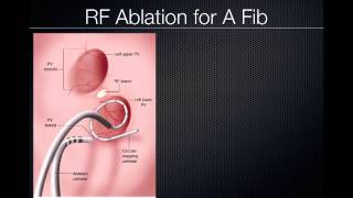 Pulmonary Vein Ablation Cardiac CT [upl. by Seaman]