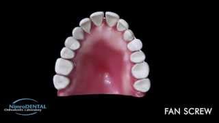 Fan Screw  Orthodontic Expansion Appliance Demo [upl. by Polinski]