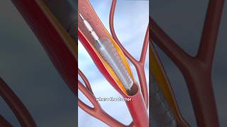 What is the Angioplasty Procedure [upl. by Droc]